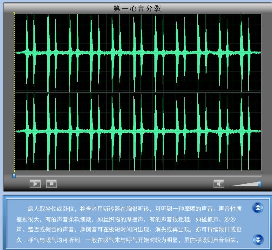 第一心音分裂-简介