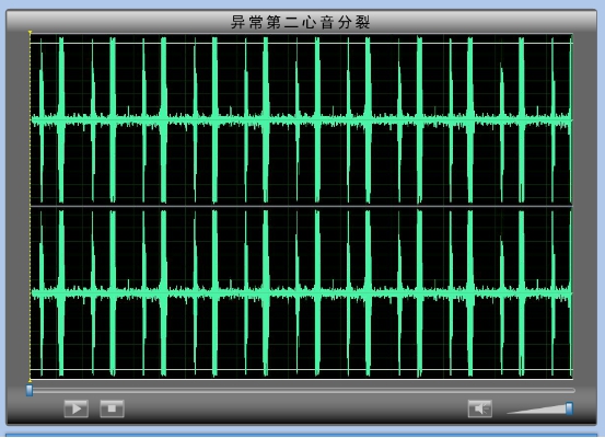 异常第二心音分裂-简介
